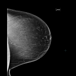 What Breast Density Means to You 1