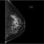 breast-post