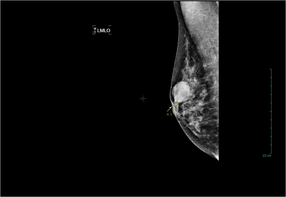 2.7cm invasive ductal carcinoma