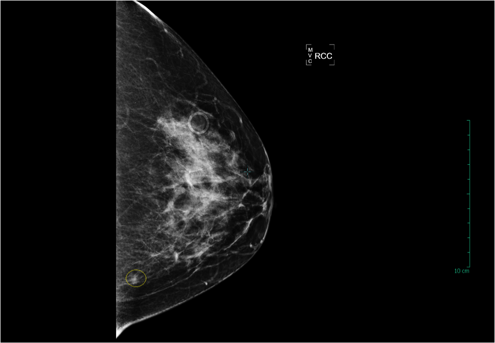 7 cm Invasive Ductal Carcinoma breast 