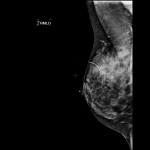 Montclair Breast Center Responds to Mammogram Controversy
